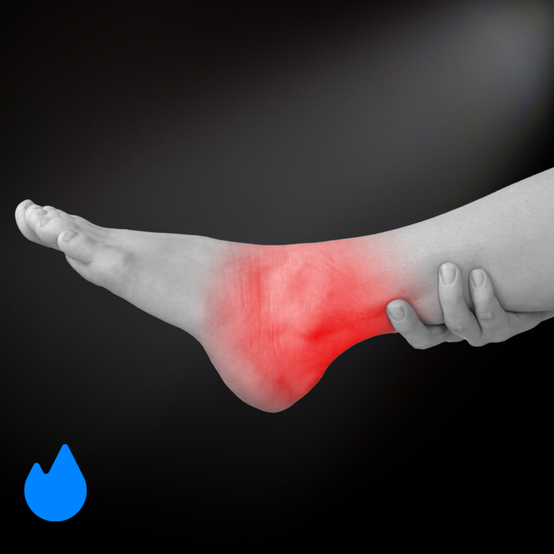 What to Do After an Ankle Sprain
